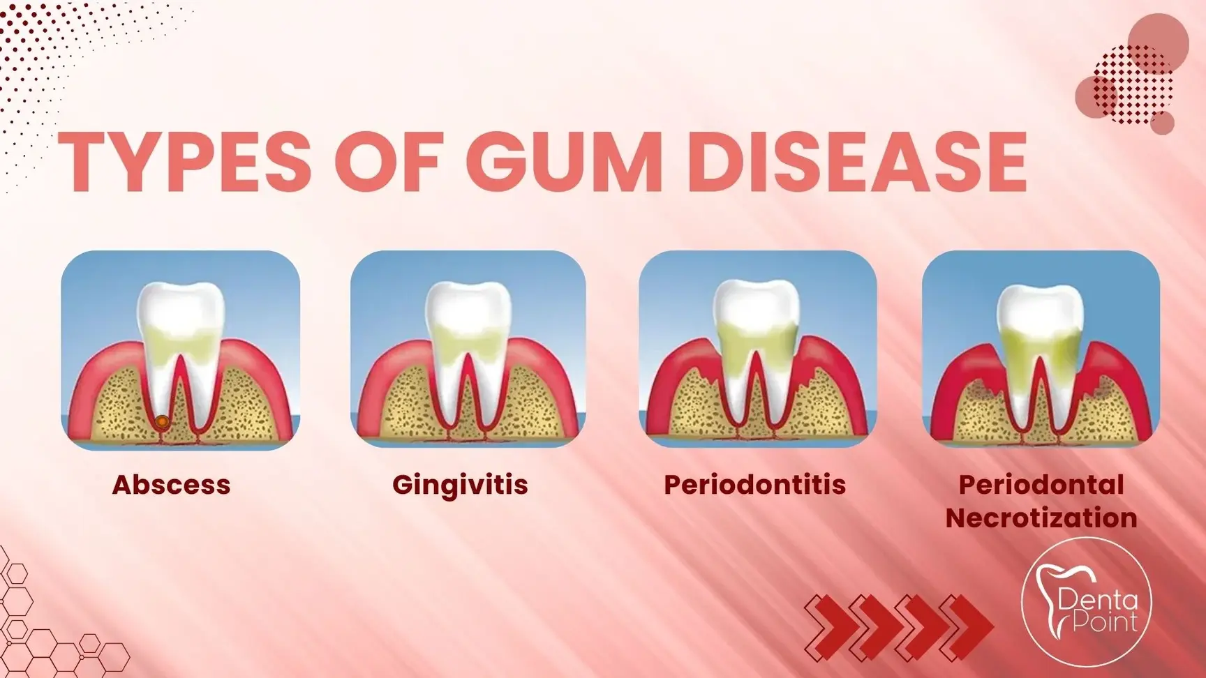 Types of gum disease